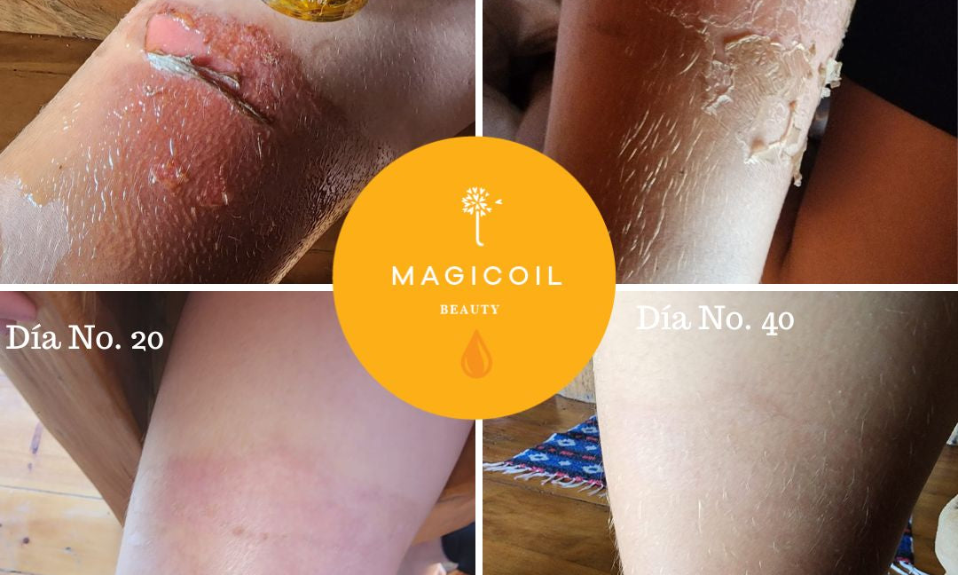Cómo sané la quemadura de segundo grado de mi hijo con amor y productos naturales